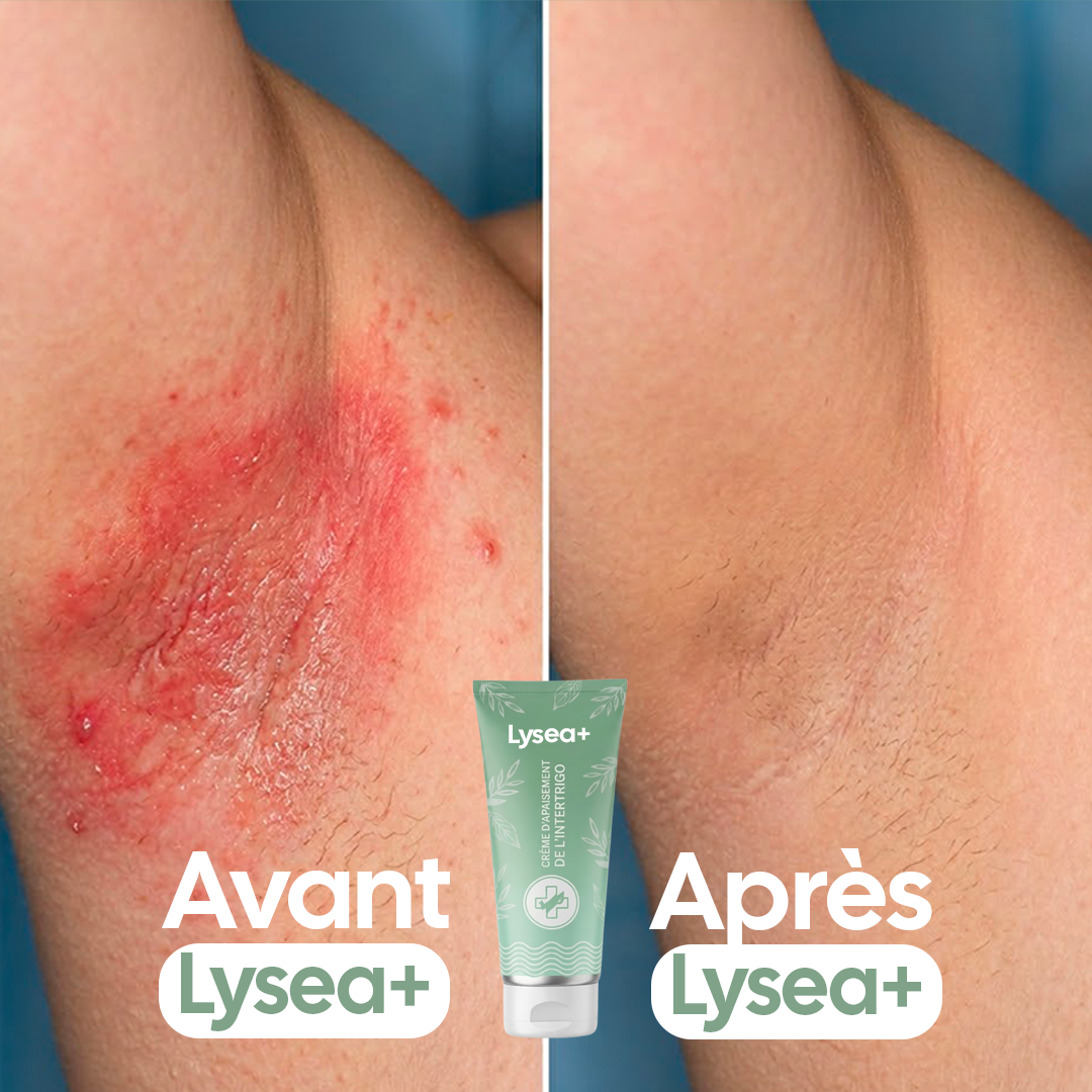 Lysea+ I Formule anti-éruption cutanée